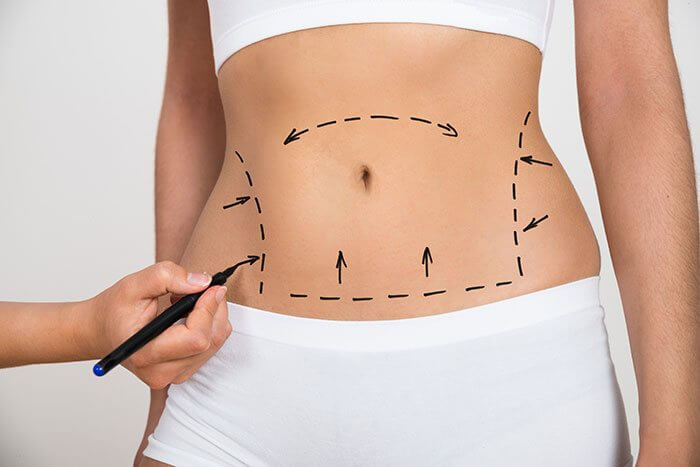 Liposuction Surgery