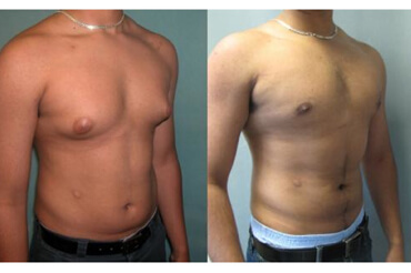 male chest reduction procedure performed