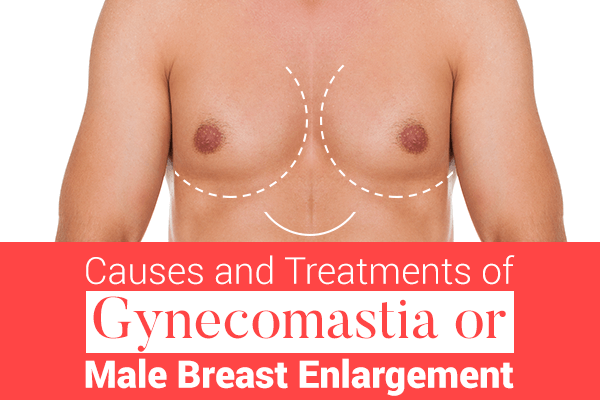 Causes and treatments of Gynecomastia or Male Breast Enlargement