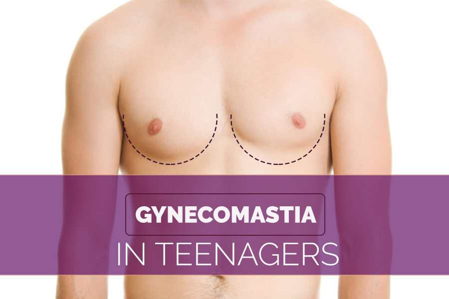 Gynecomastia in Teenagers