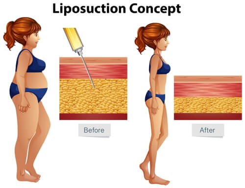 Liposuction Before and After Comparison