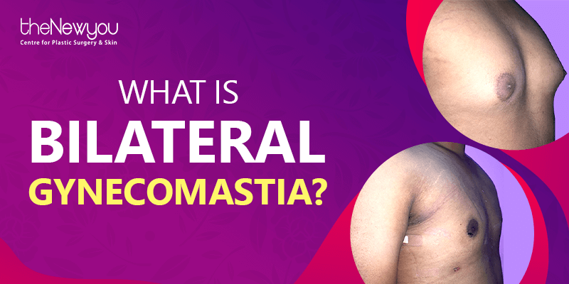 What is Bilateral Gynecomastia