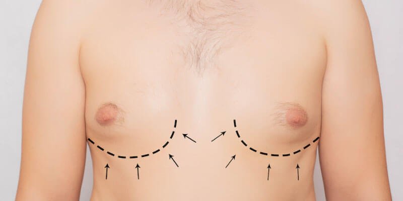 Get a Flat Chest with Male Breast Reduction