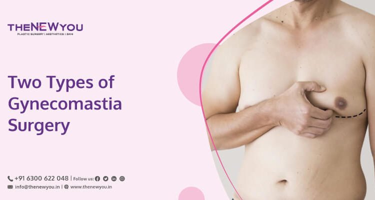 What are the Types of Gynecomastia Surgery