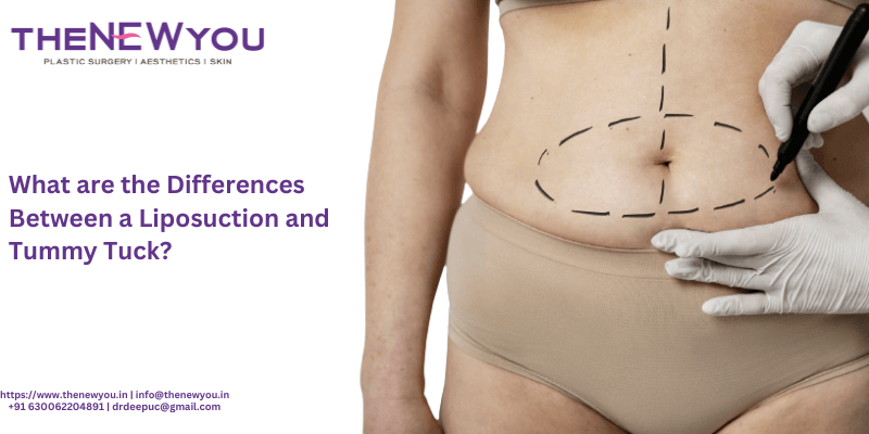 What are The Differences Between a Liposuction and Tummy Tuck