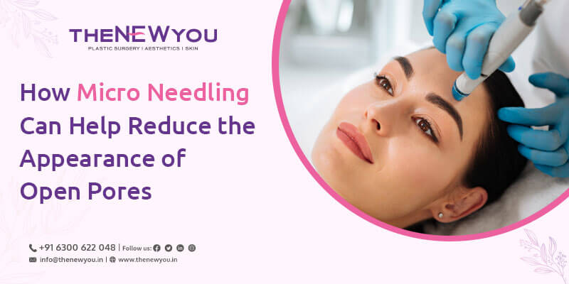 Micro-Needling