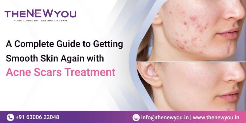 A Complete Guide to Getting Smooth Skin Again with acne scars treatment