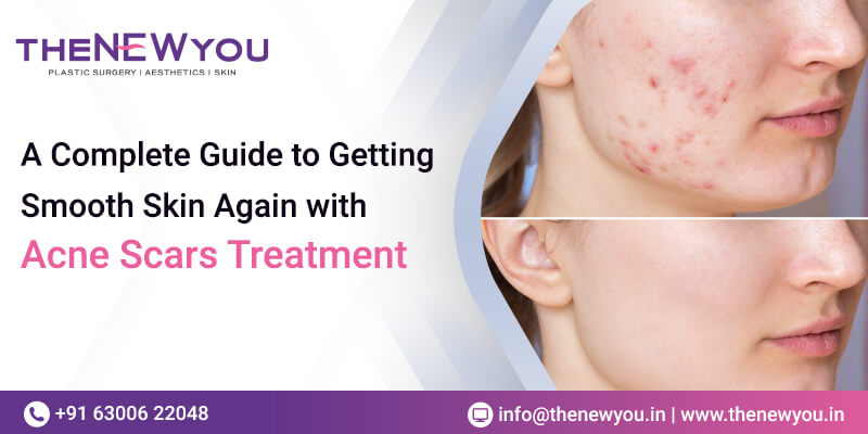 Acne-Scars-Treatment