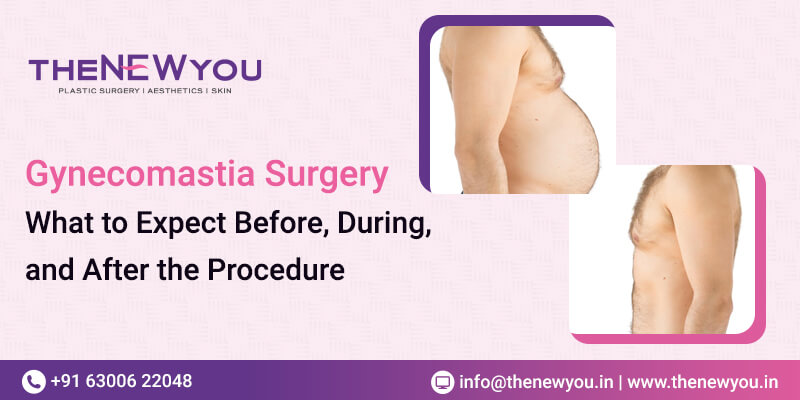 Gynecomastia-Surgery