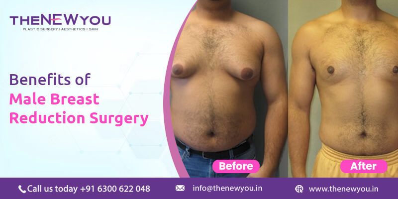 Male breast reduction surgery