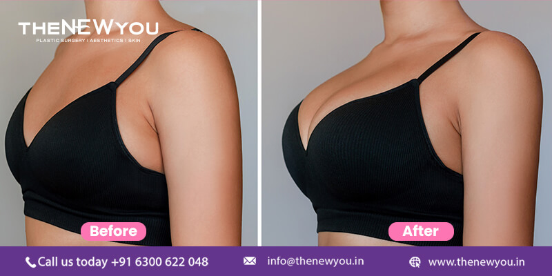 Breast Augmentation Revision Procedure