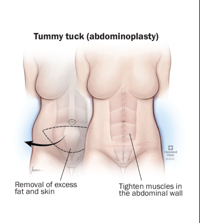 Tummy Tuck