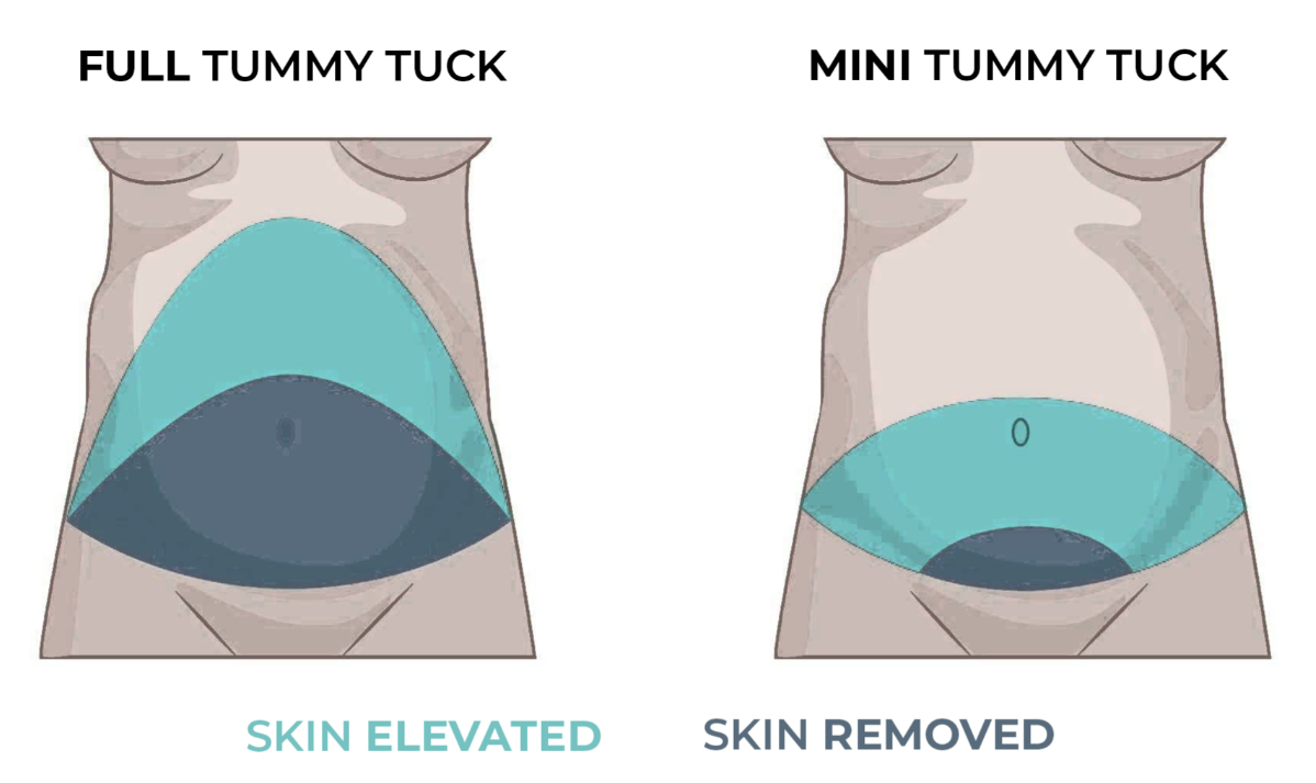 Tummy Tuck