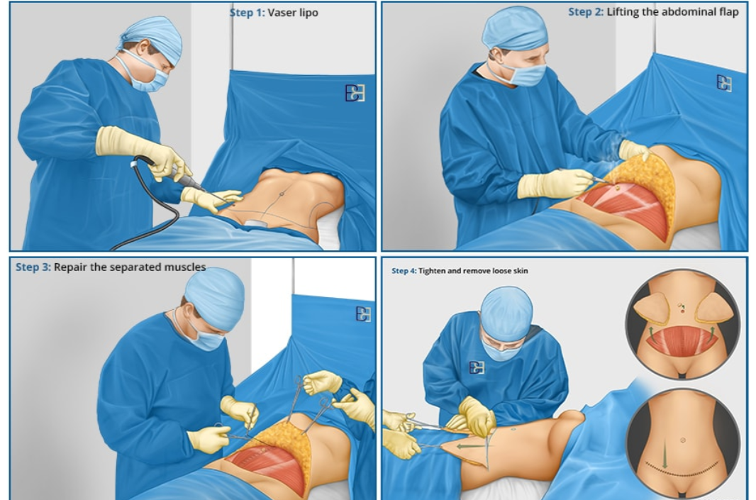 Tummy Tuck Surgery