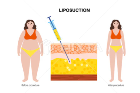 Illustration comparing a body before and after liposuction, with a cross-section diagram showing a cannula removing fat beneath the skin