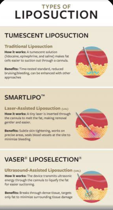 Infographic titled "Types of Liposuction" comparing tumescent, laser-assisted (SmartLipo), and ultrasound-assisted (Vaser) techniques with cross-section diagrams