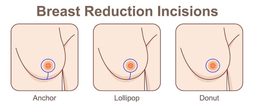 breast reduction