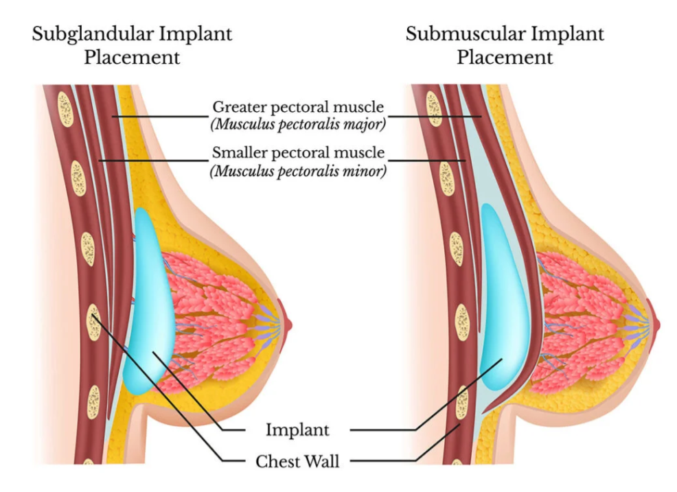 Silicone breast