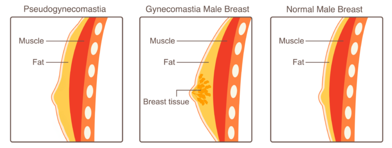 Gynecomastia
