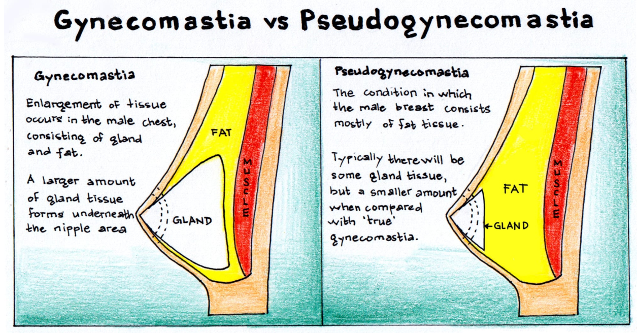 Pseudogynecomastia vs Gynecomastia
