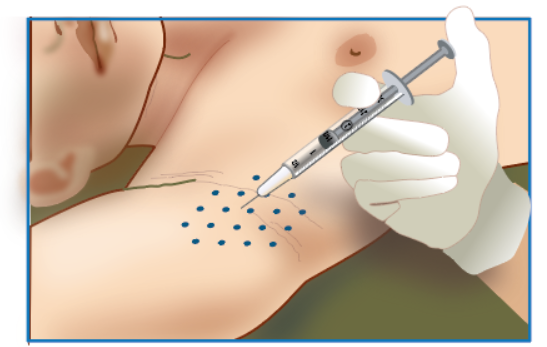 Hyperhidrosis