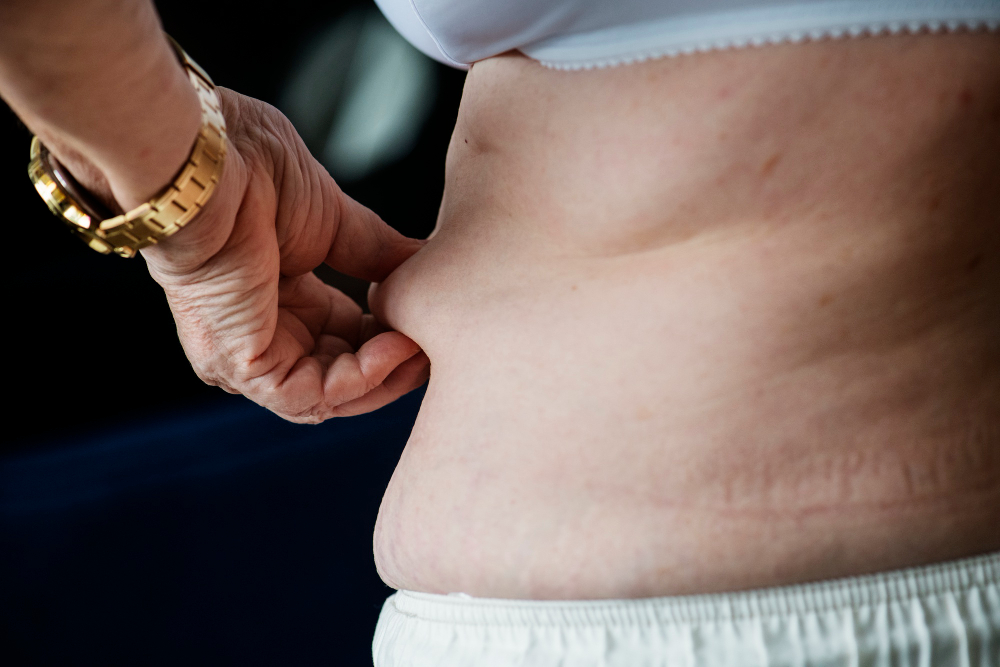 loose skin after liposuction