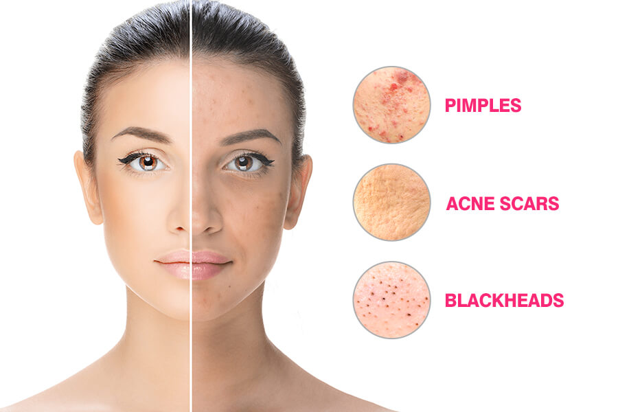 What Are The Main Acne Issues And How To Deal With Them Dr Sushma Raavi