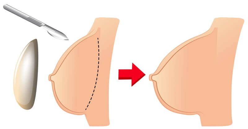 Do Breast Implants Sag over time