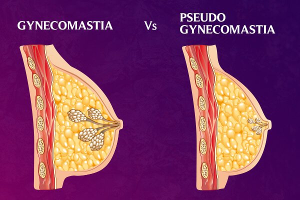 Gynecomastia vs Pseudogynecomastia
