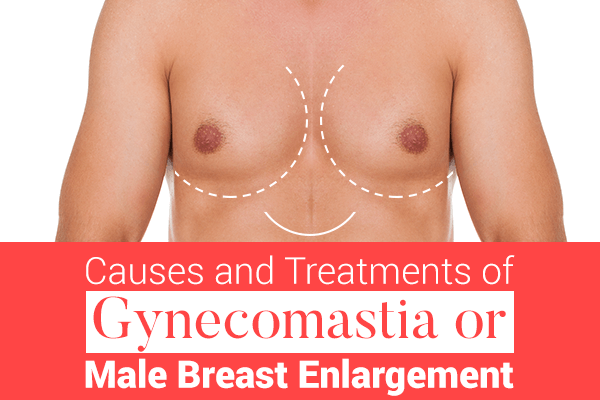 Treantments of Gynecomastia
