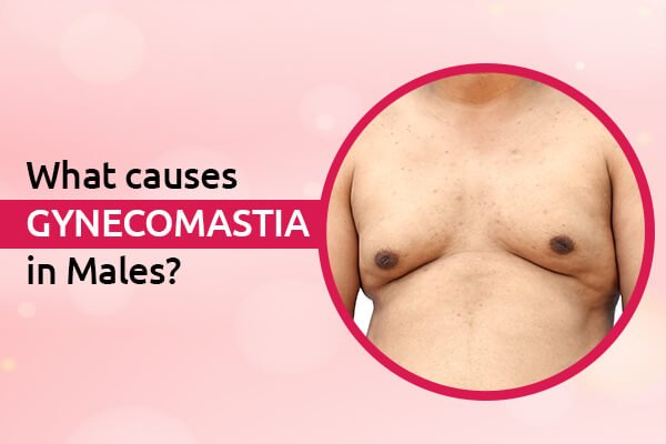 What causes Gynecomastia in Males