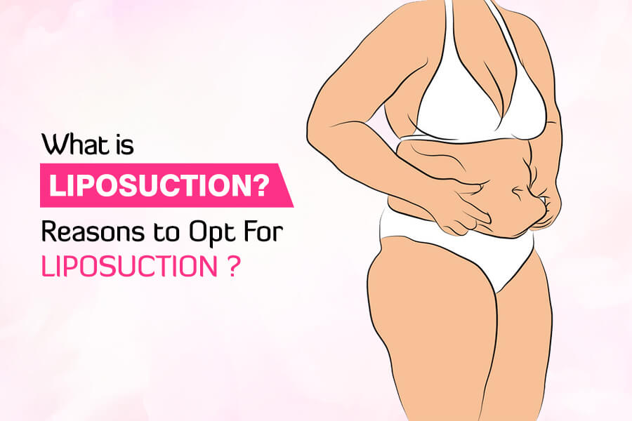 What is Liposuction Reasons to Opt For Liposuction