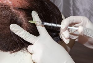 stem cell therapy for hair
